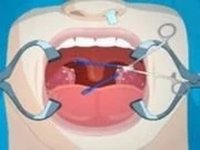 Tonsil Surgery Online Game